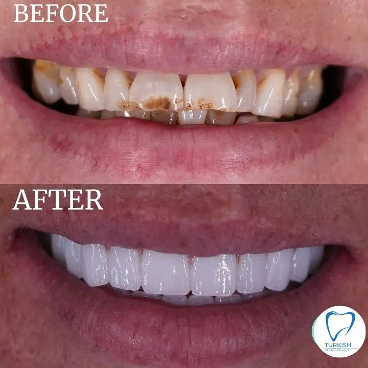 Dental implant patient review