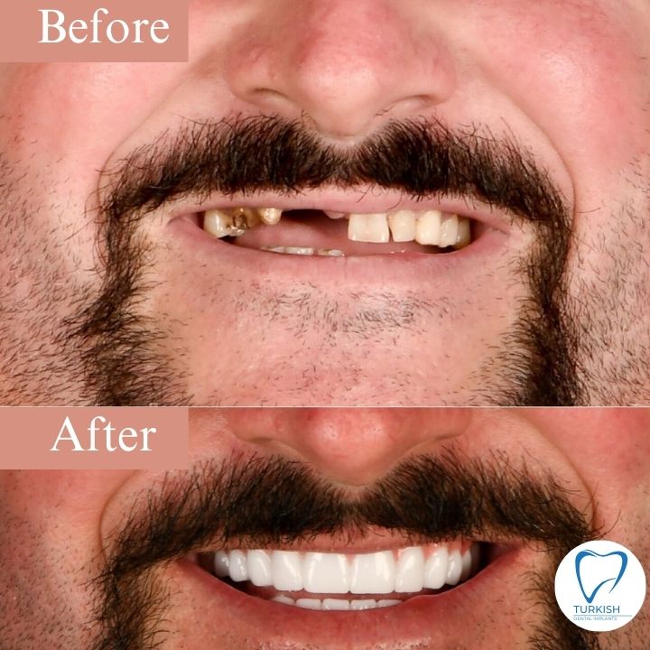 before and after turkey teeth