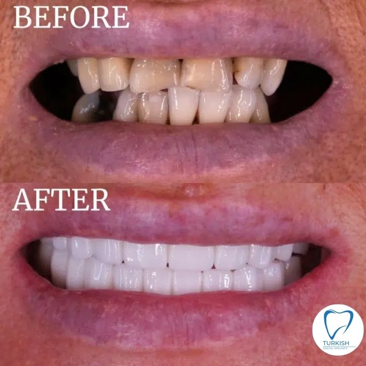 dental implant before after