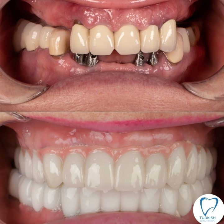 teeth before and after