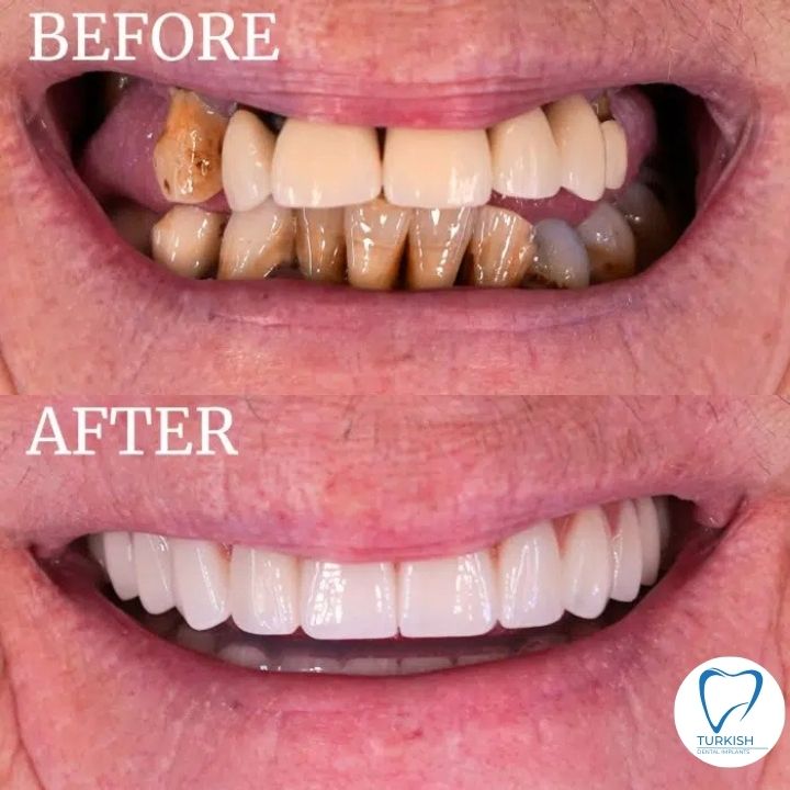 turkey teeth before and after