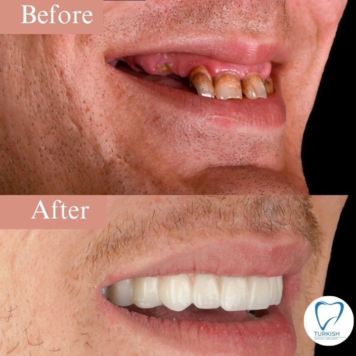 turkey tooth before and after