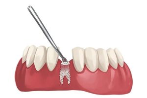 Bone graft