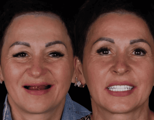 Full Mouth Implants