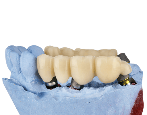 Implant-Supported Dentures