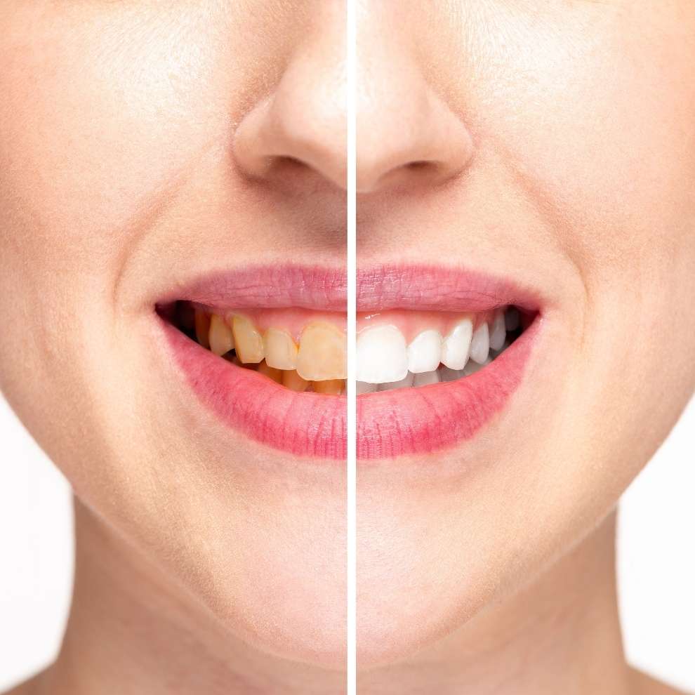 Laser Teeth Whitening in turkey results