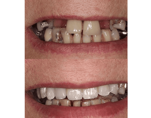 Multiple Tooth Implants