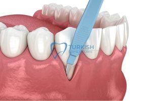 Periodontal Surgery