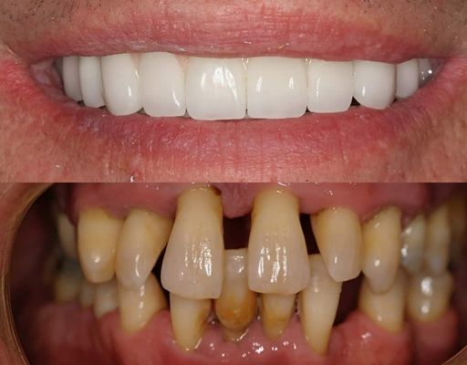 Same-day Dental Implants