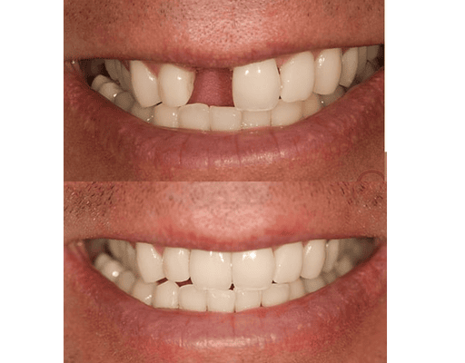 Stainless Steel Implant