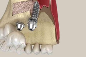 Sinus Lift Surgery