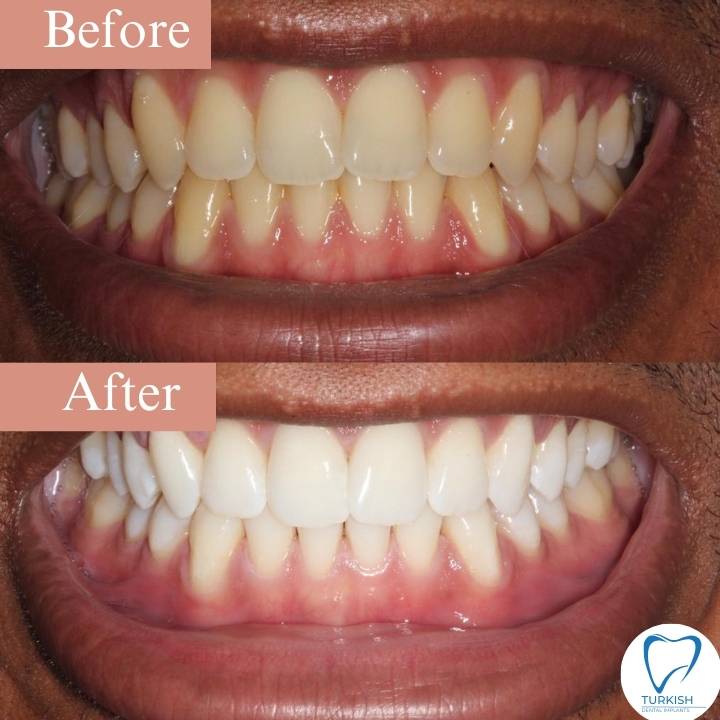 Teeth whitening