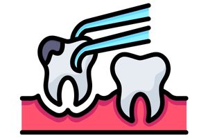 Tooth Extraction