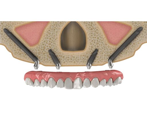 Zygomatic Implants
