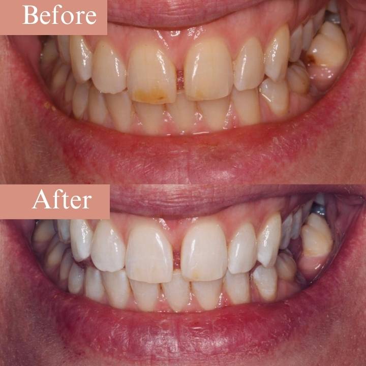 before and after laser teeth whitening turkey