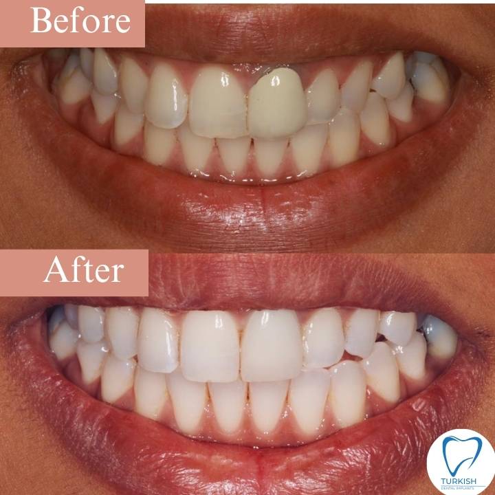 teeth whitening turkey reviews