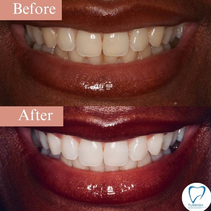 turkey laser tooth whitening