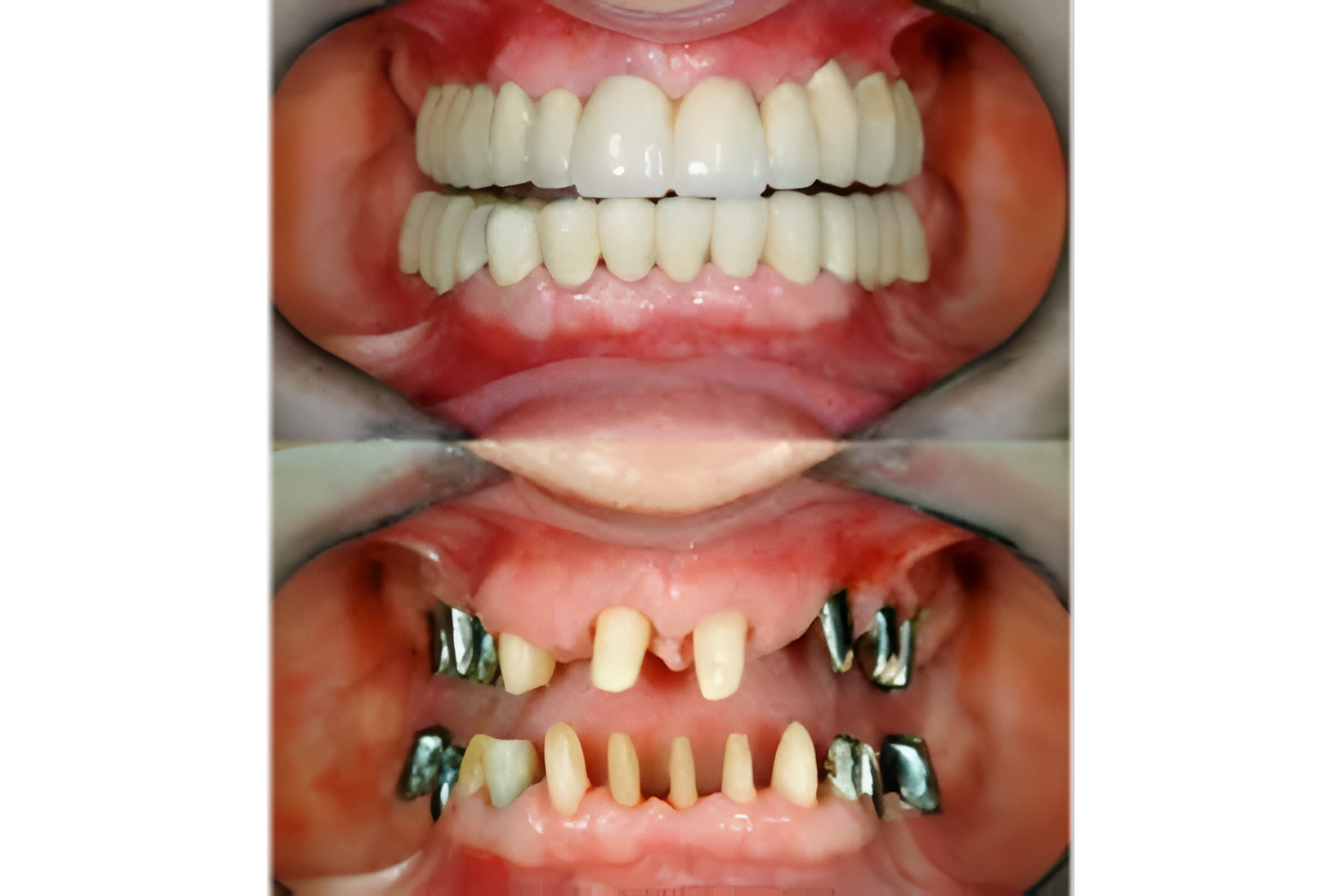 Full-Mouth-Implants.webp