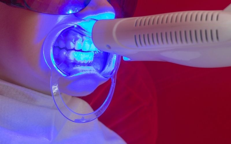 Laser Teeth Whitening
