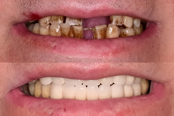 Multiple-Tooth-Implants.webp