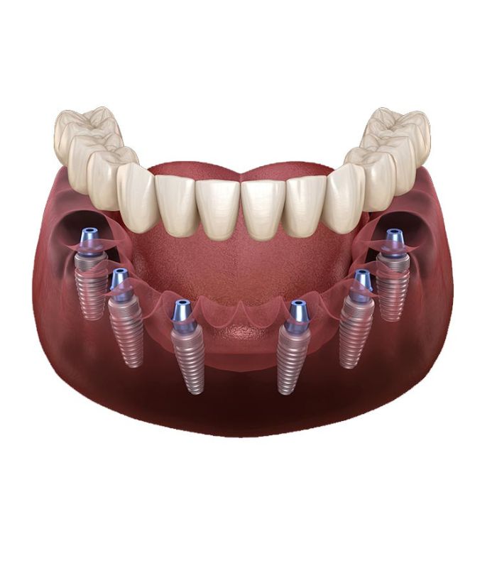 6 Dental Implants