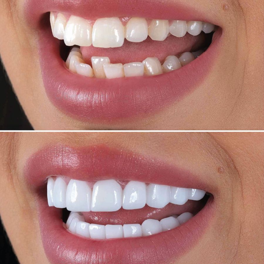 Dental Crowns