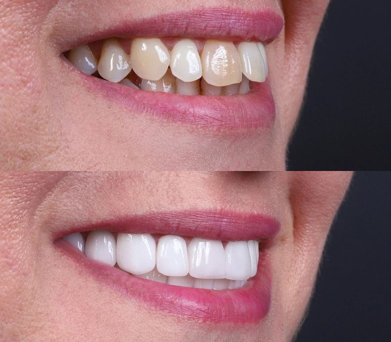 Full Mouth Dental Implants Turkey Package Deals