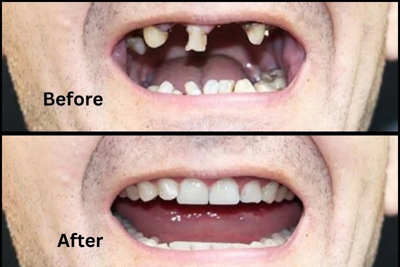 Dental Lumineers in Turkey: Cost, Process