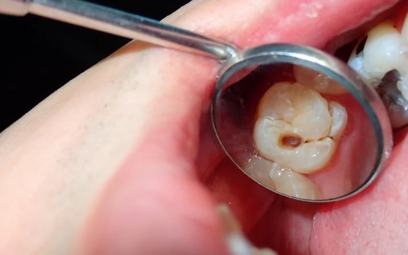 When is a Dental Filling Necessary?