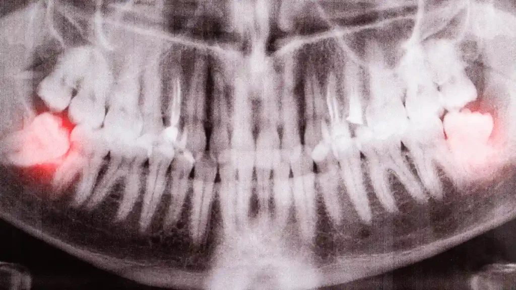 Day-By-Day-Wisdom-Teeth-Recovery-Timeline (2)