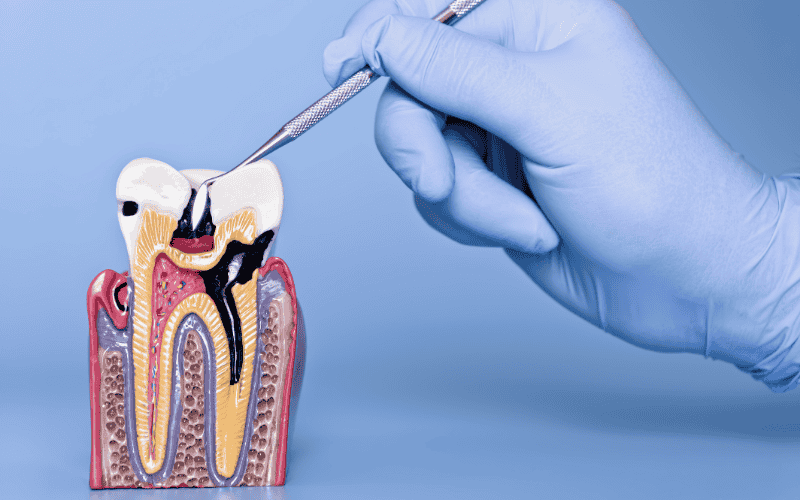 Diagnosis and Dental Tests for Wisdom Tooth Cavities