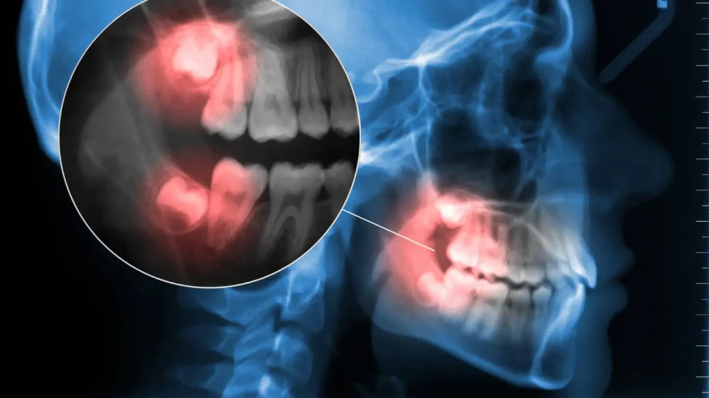 Does-Everyone-Have-Wisdom-Teeth