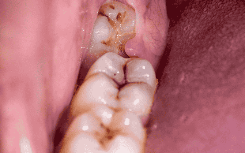 How To Get Food Out Of Wisdom Tooth Hole