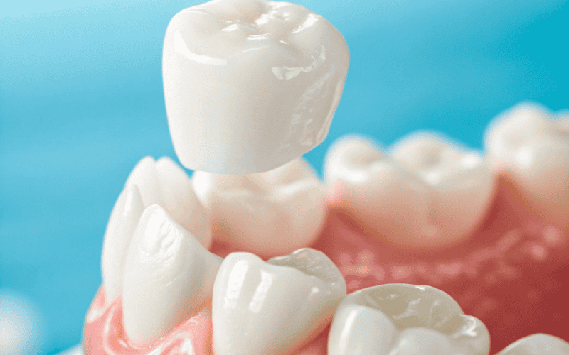 Tooth Cap vs Crown