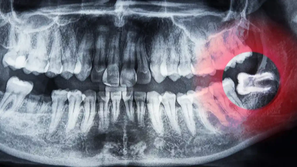 What-Can-I-Eat-After-Wisdom-Teeth-Removal (1)