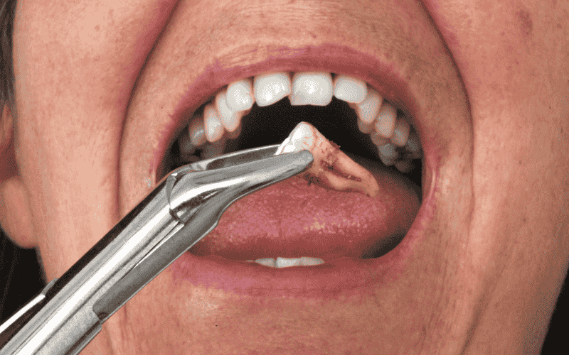 When and How to Use a Syringe, Irrigator, or Brush After Extraction