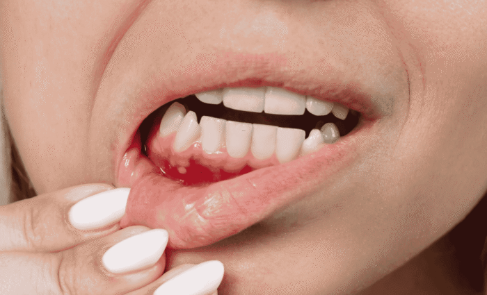 gums grafting