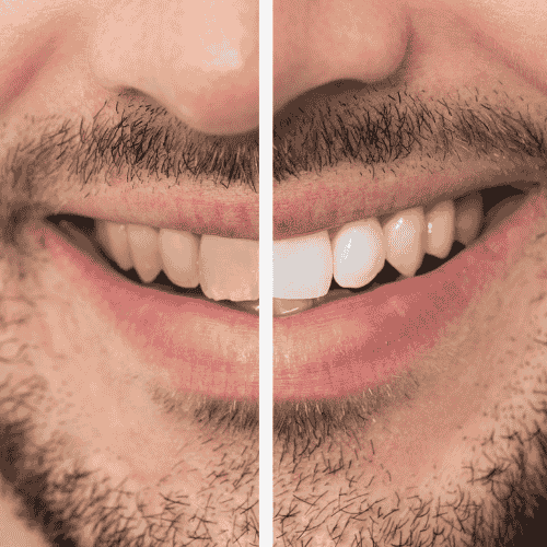Celebrity Dental Implants Before And After