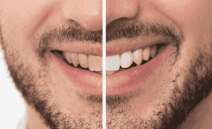 Celebrity Dental Implants Before And After