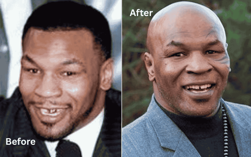 Mike Tyson before and after teeth