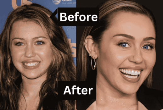 Miley Cyrus Veneers Before & After