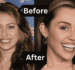 Miley Cyrus Veneers: Before And After 2026