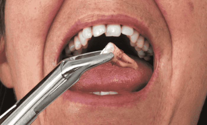 Wisdom Teeth Symptoms That Indicate Time Extraction