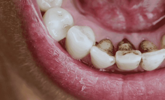 how to get rid of teeth stains?
