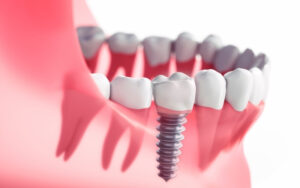 How Long To Stay In Turkey For Dental Implants