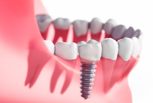 How Long To Stay In Turkey For Dental Implants