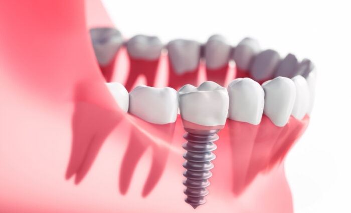How Long To Stay In Turkey For Dental Implants