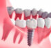 How Long Do Dental Implants Take in Turkey